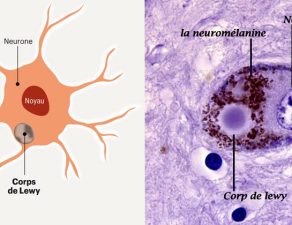 maladie-corps-de-lewy