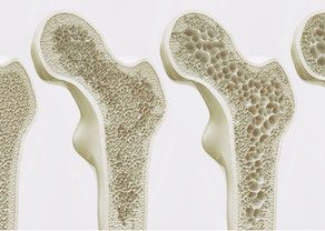 image-pathologie-osteoporose